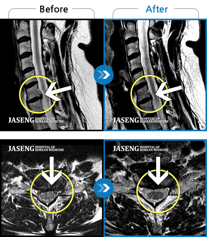 목동자생한방병원 치료 전후 MRI 비교 이미지