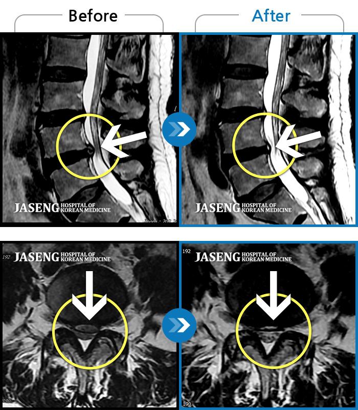 목동자생한방병원 치료 전후 MRI 비교 이미지