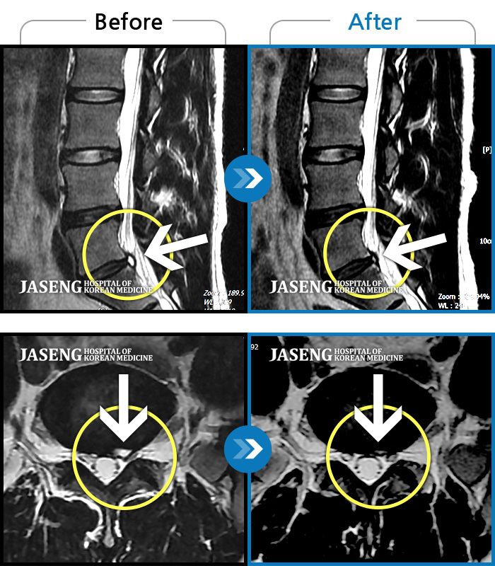목동자생한방병원 치료 전후 MRI 비교 이미지