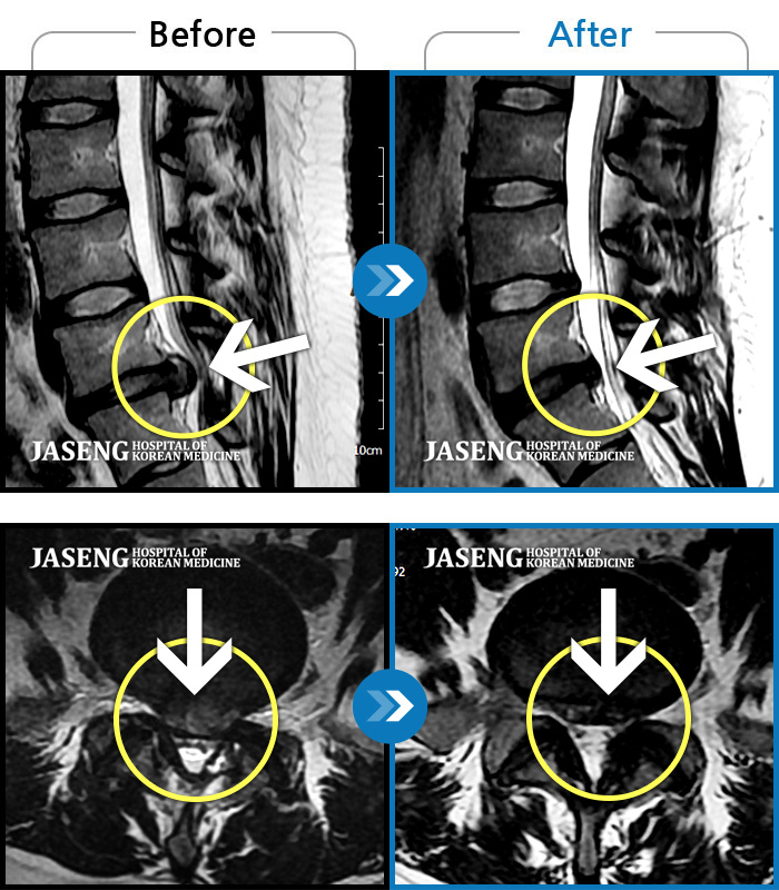 목동자생한방병원 치료 전후 MRI 비교 이미지