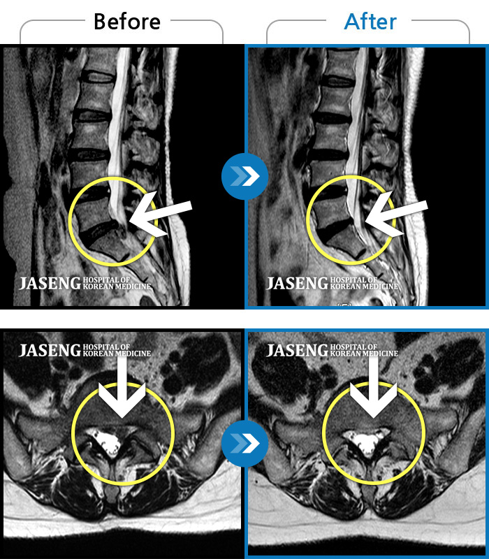 인천자생한방병원 치료 전후 MRI 비교 이미지