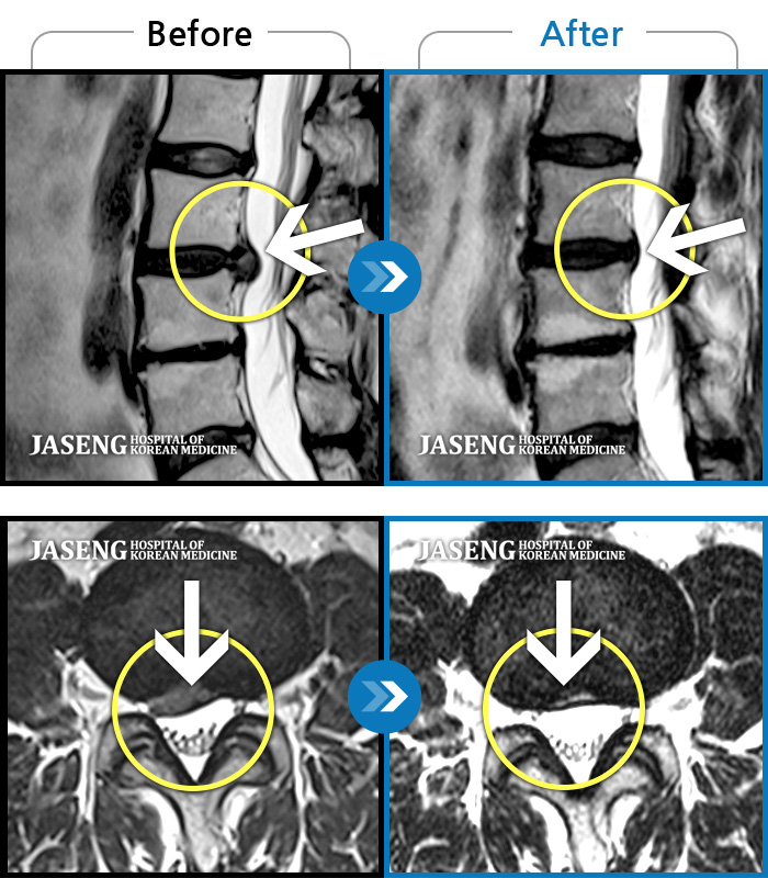 자생한방병원 치료 전후 MRI 비교 이미지