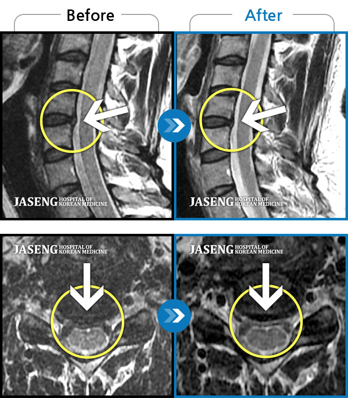 해운대자생한방병원 치료 전후 MRI 비교 이미지