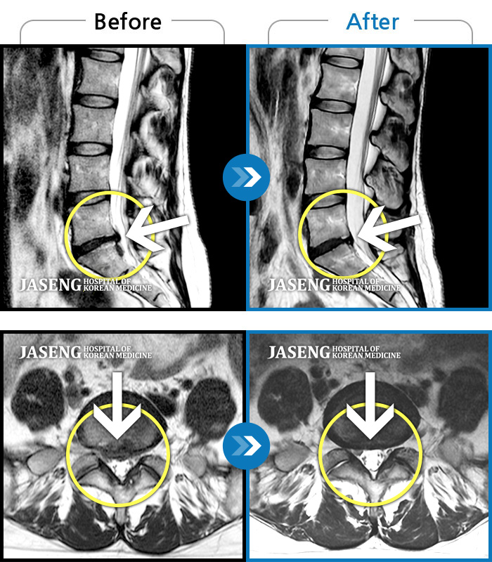 자생한방병원 치료 전후 MRI 비교 이미지