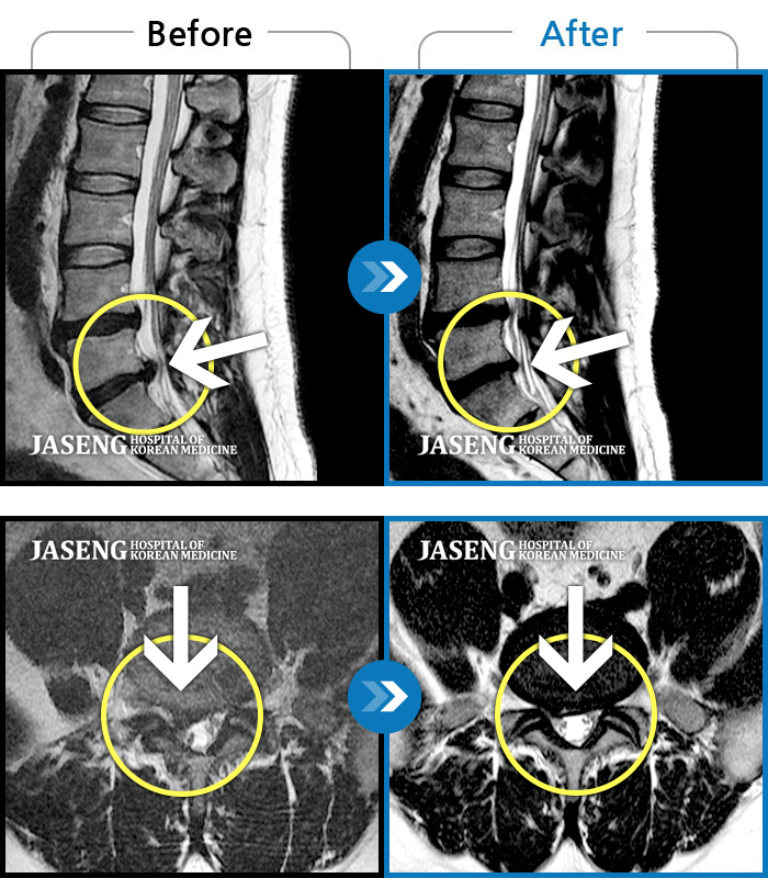 자생한방병원 치료 전후 MRI 비교 이미지
