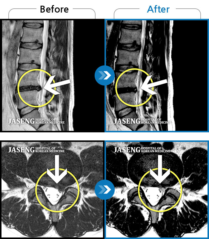 자생한방병원 치료 전후 MRI 비교 이미지