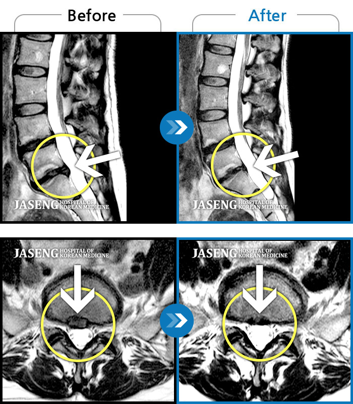 자생한방병원 치료 전후 MRI 비교 이미지
