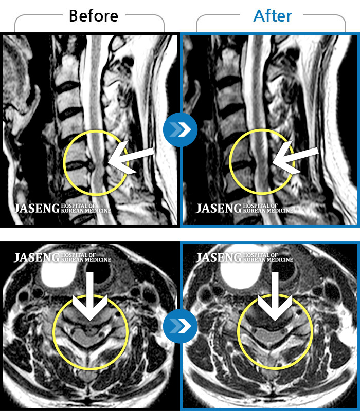 자생한방병원 치료 전후 MRI 비교 이미지