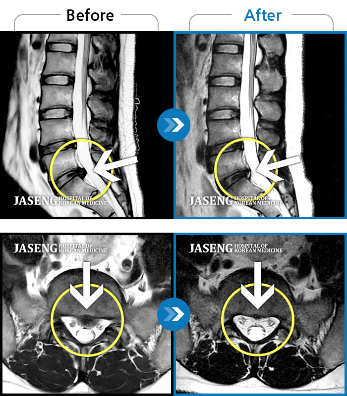 수원자생한방병원 치료 전후 MRI 비교 이미지