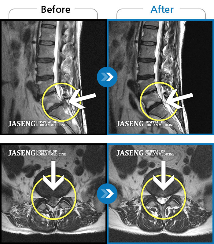 잠실자생한방병원 치료 전후 MRI 비교 이미지