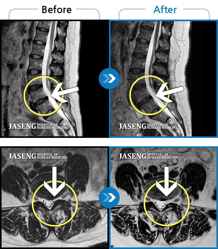 인천자생한방병원 치료 전후 MRI 비교 이미지