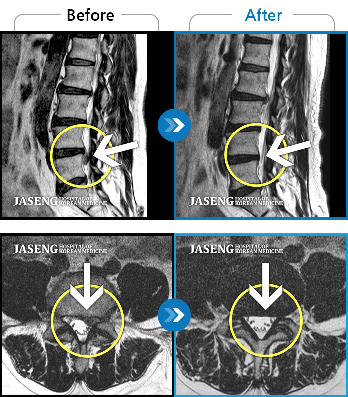 인천자생한방병원 치료 전후 MRI 비교 이미지