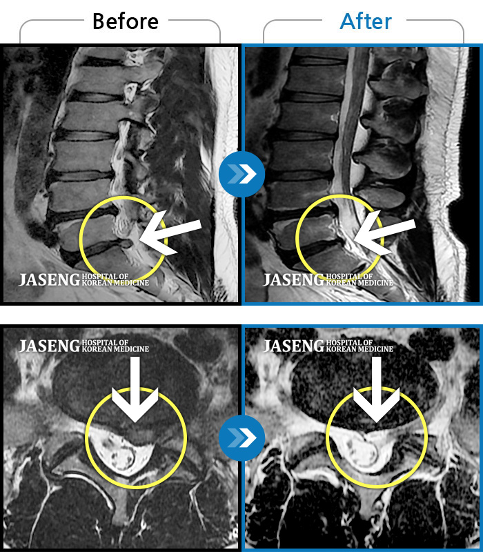 해운대자생한방병원 치료 전후 MRI 비교 이미지