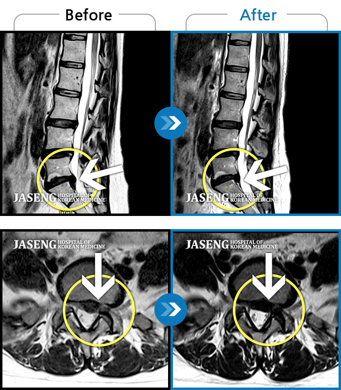 광주자생한방병원 치료 전후 MRI 비교 이미지