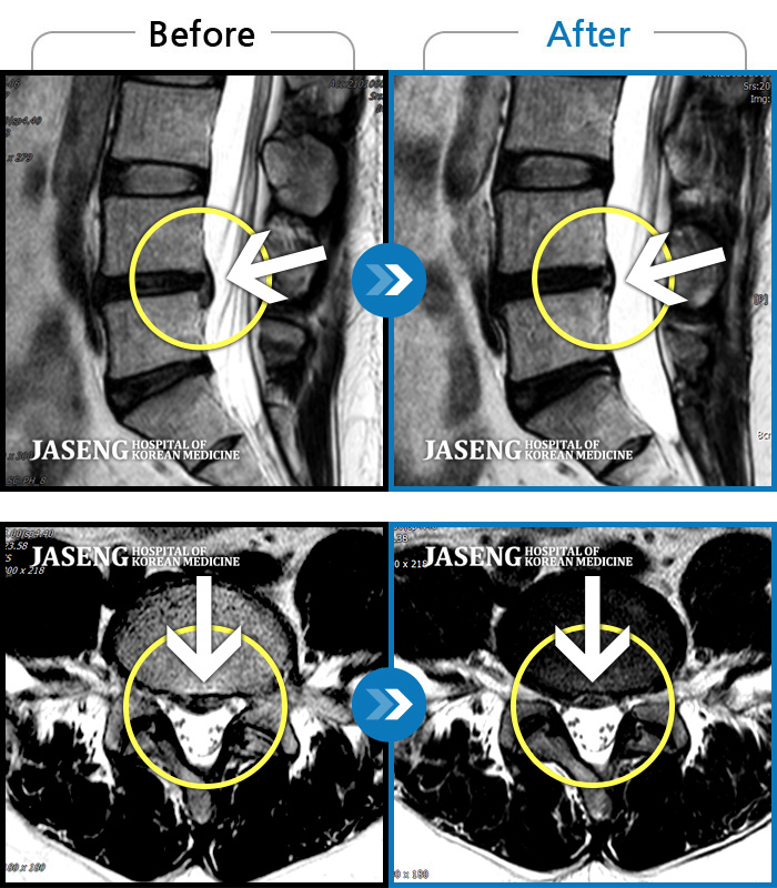 자생한방병원 치료 전후 MRI 비교 이미지