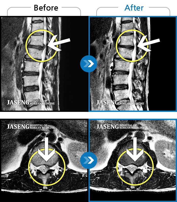 청주자생한방병원 치료 전후 MRI 비교 이미지