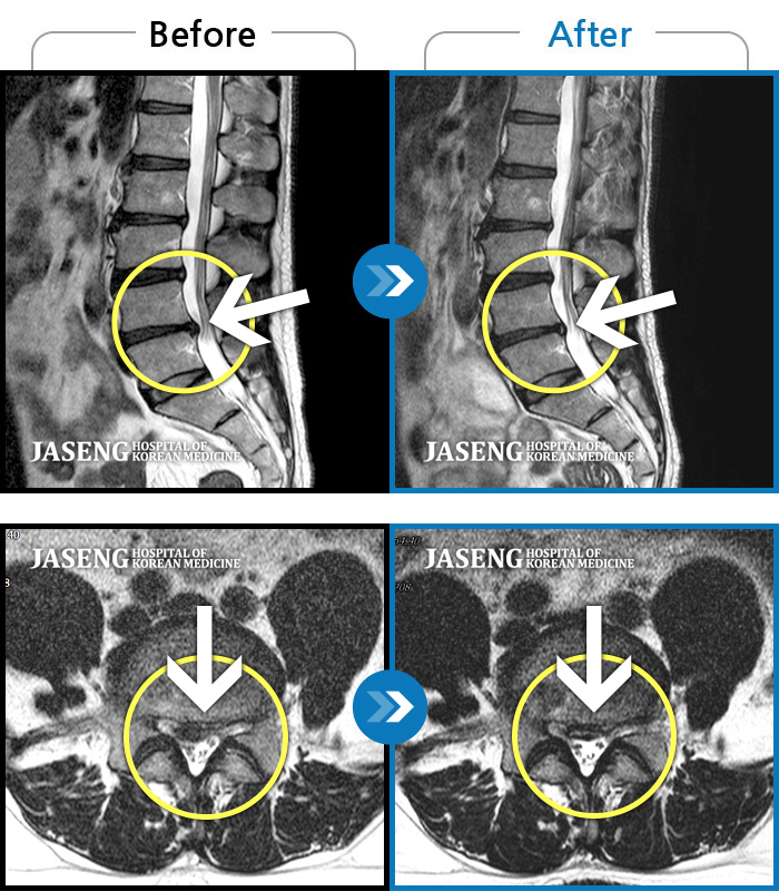 인천자생한방병원 치료 전후 MRI 비교 이미지