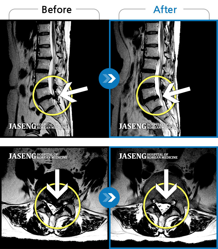 대전자생한방병원 치료 전후 MRI 비교 이미지
