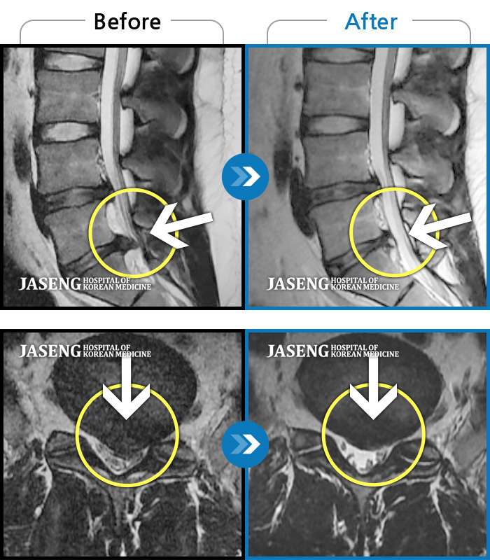 해운대자생한방병원 치료 전후 MRI 비교 이미지