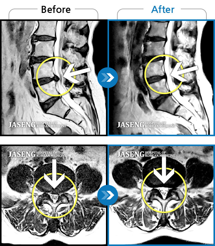 안산자생한방병원 치료 전후 MRI 비교 이미지