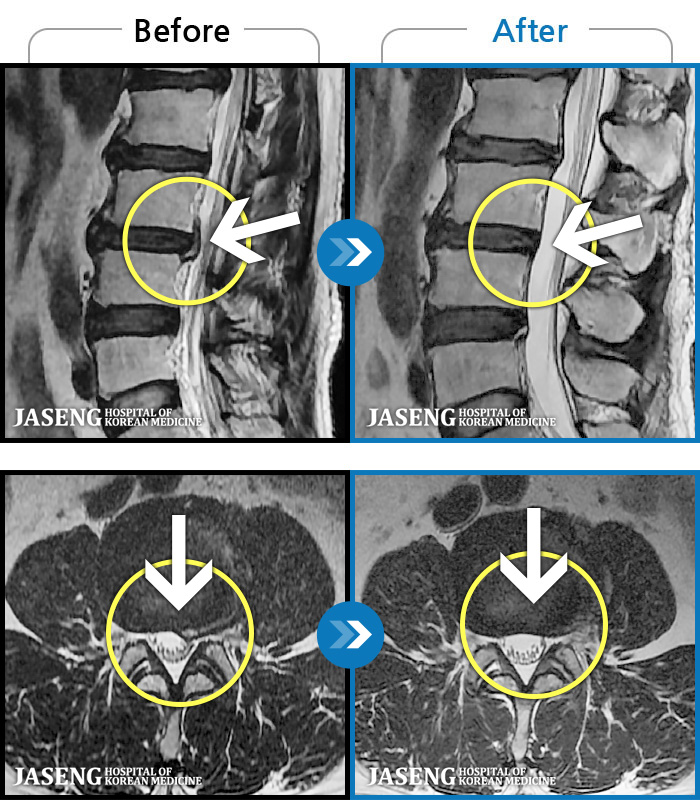 해운대자생한방병원 치료 전후 MRI 비교 이미지
