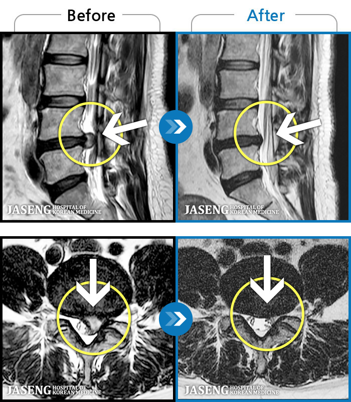 인천자생한방병원 치료 전후 MRI 비교 이미지