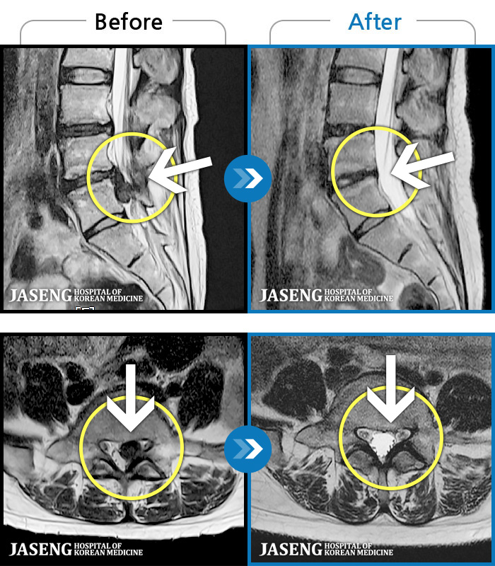 인천자생한방병원 치료 전후 MRI 비교 이미지