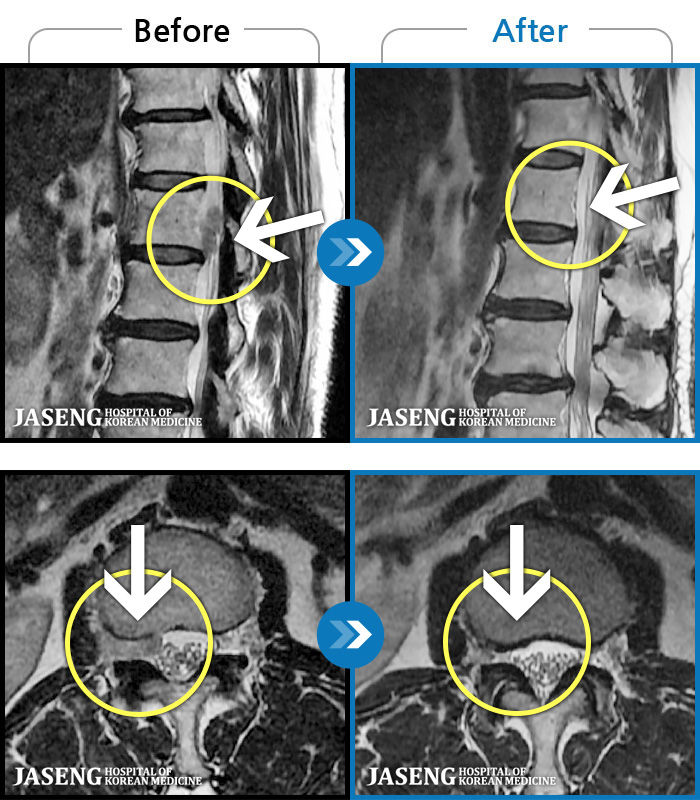 해운대자생한방병원 치료 전후 MRI 비교 이미지