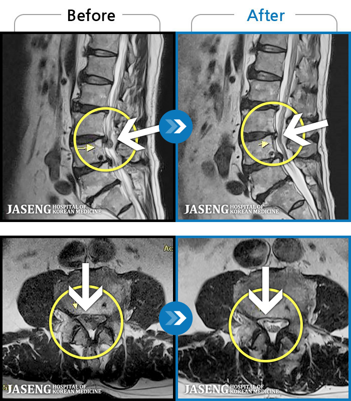 광주자생한방병원 치료 전후 MRI 비교 이미지