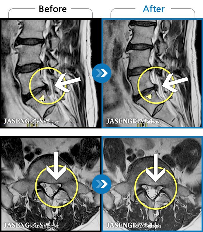 광주자생한방병원 치료 전후 MRI 비교 이미지