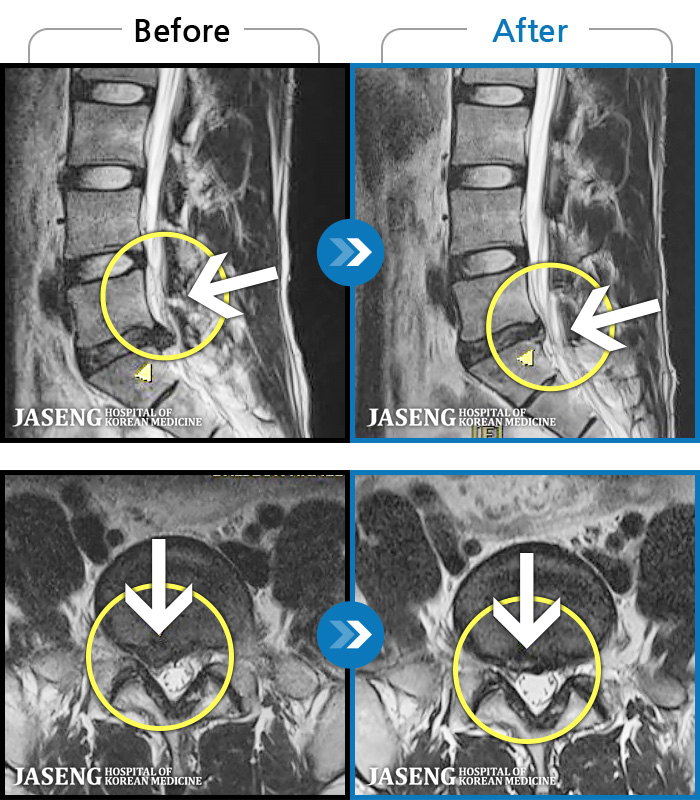 광주자생한방병원 치료 전후 MRI 비교 이미지