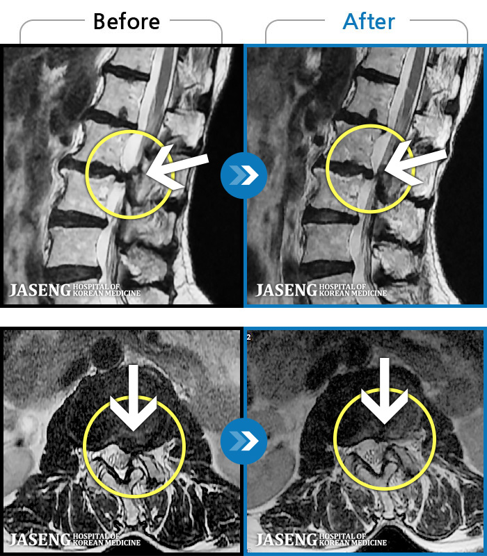 해운대자생한방병원 치료 전후 MRI 비교 이미지
