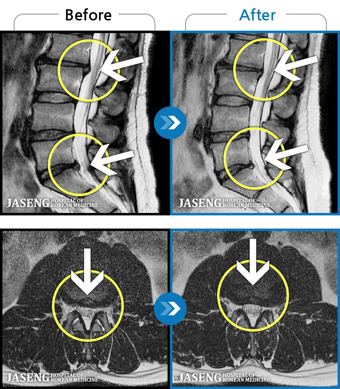 인천자생한방병원 치료 전후 MRI 비교 이미지