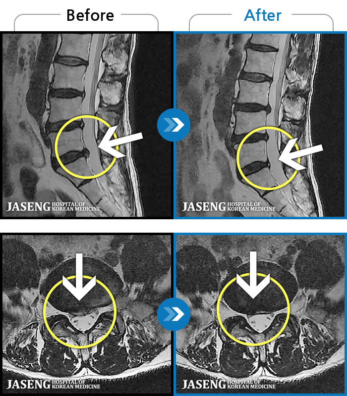 일산자생한방병원 치료 전후 MRI 비교 이미지