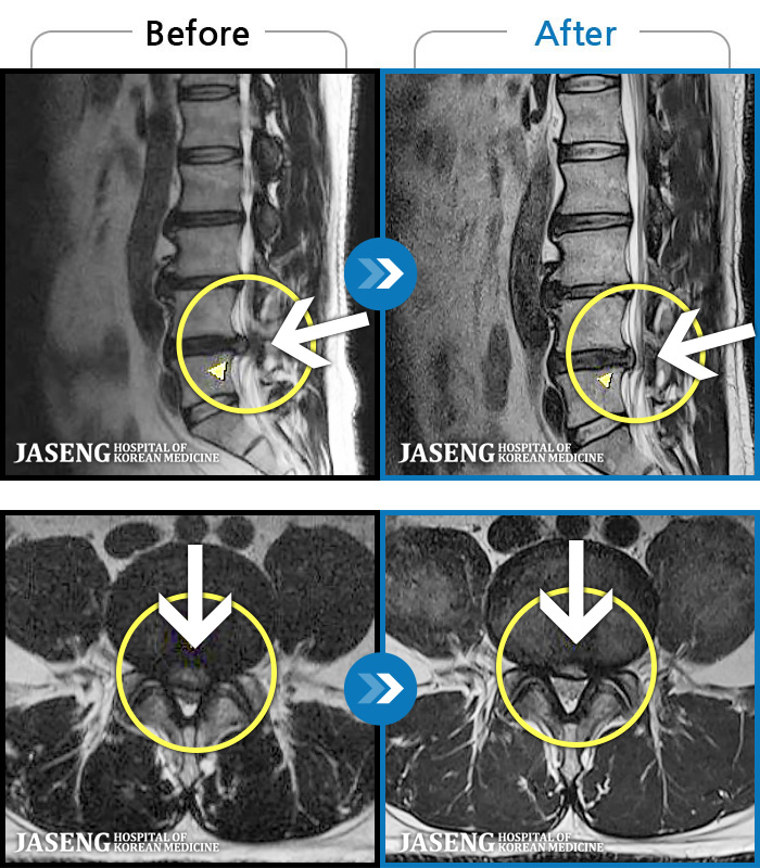 광주자생한방병원 치료 전후 MRI 비교 이미지