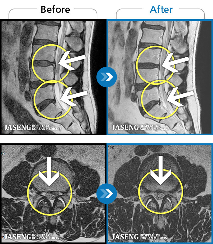 인천자생한방병원 치료 전후 MRI 비교 이미지