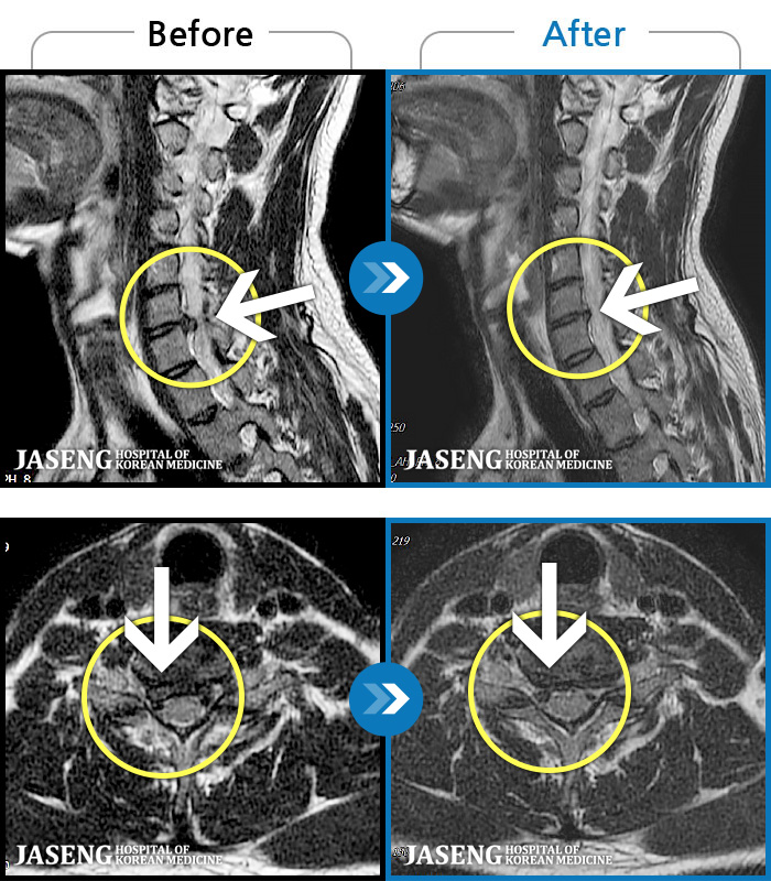 인천자생한방병원 치료 전후 MRI 비교 이미지