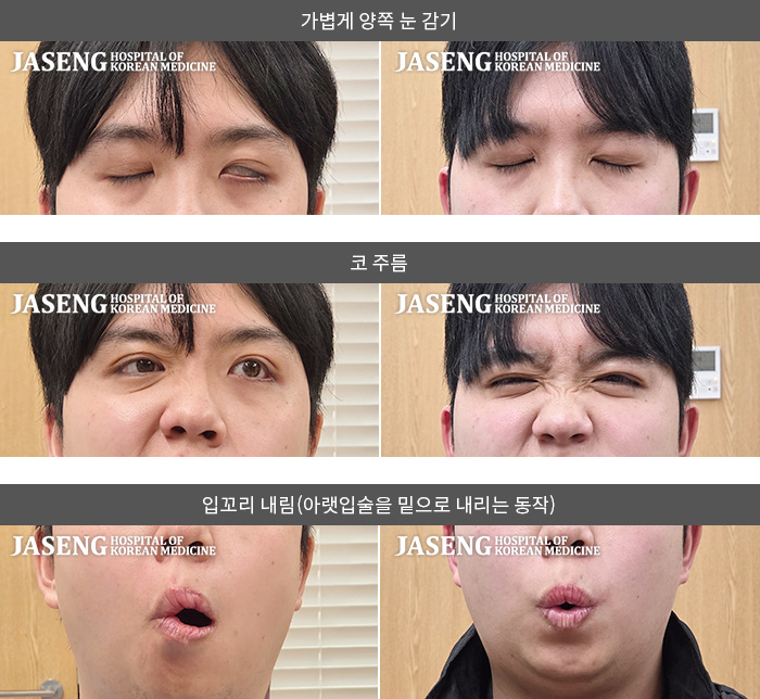 보라매자생한방병원-안면신경마비 치료 전후 사례