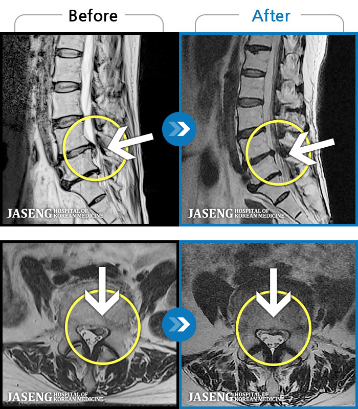 일산자생한방병원 치료 전후 MRI 비교 이미지