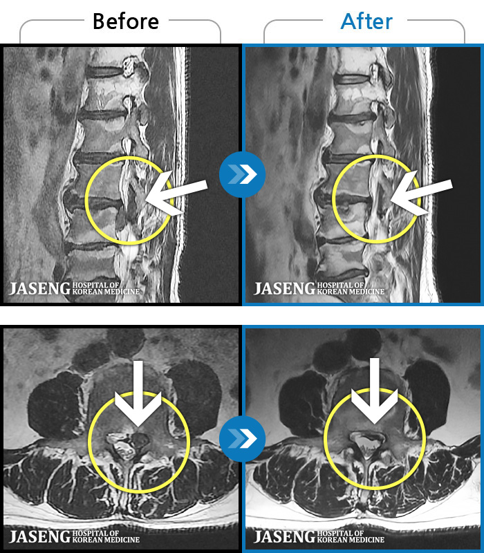 청주자생한방병원 치료 전후 MRI 비교 이미지