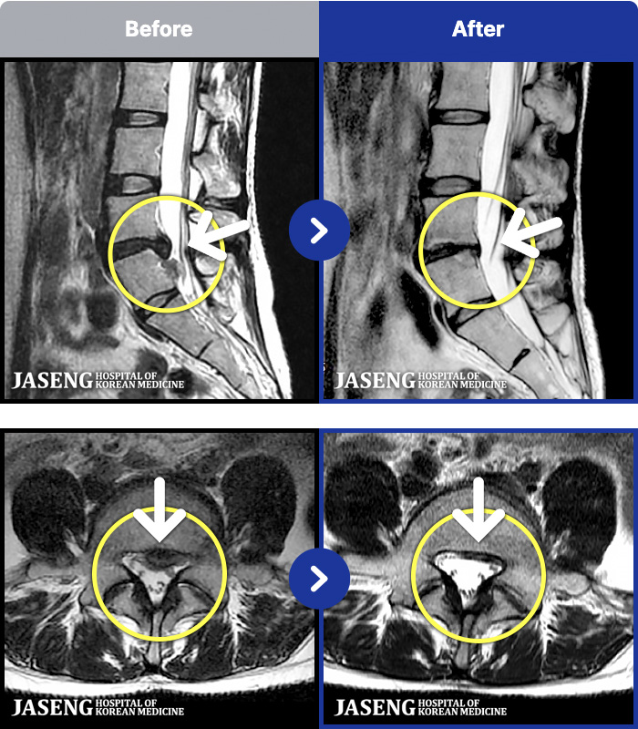 자생한방병원 치료 전후 MRI 비교 이미지