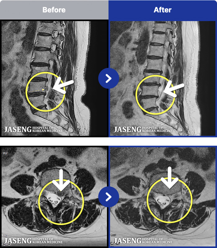 인천자생한방병원 치료 전후 MRI 비교 이미지