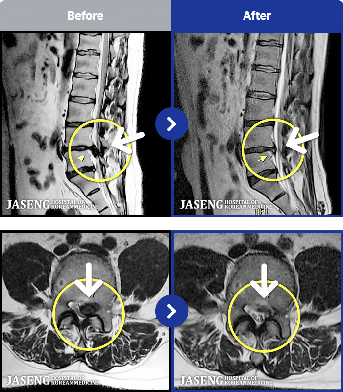 광주자생한방병원 치료 전후 MRI 비교 이미지