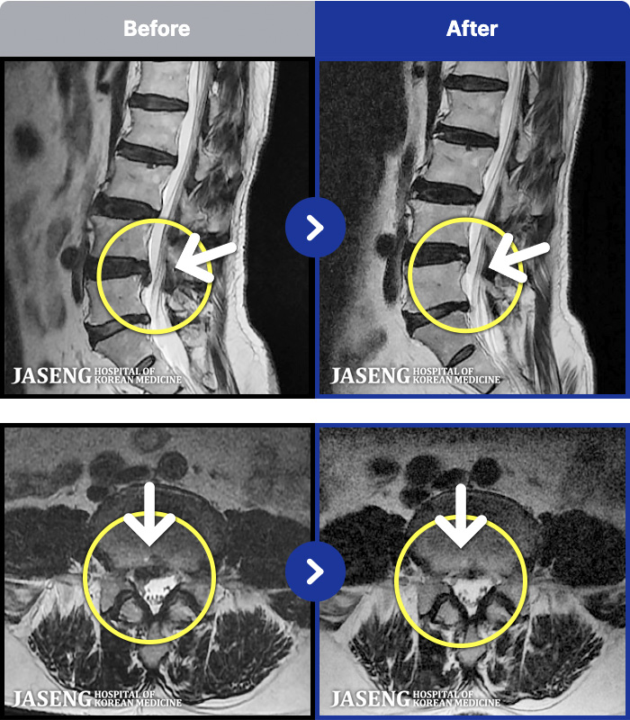 해운대자생한방병원 치료 전후 MRI 비교 이미지