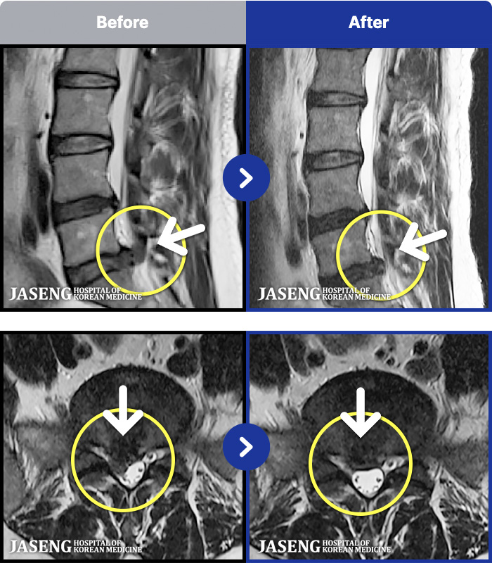창원자생한방병원 치료 전후 MRI 비교 이미지