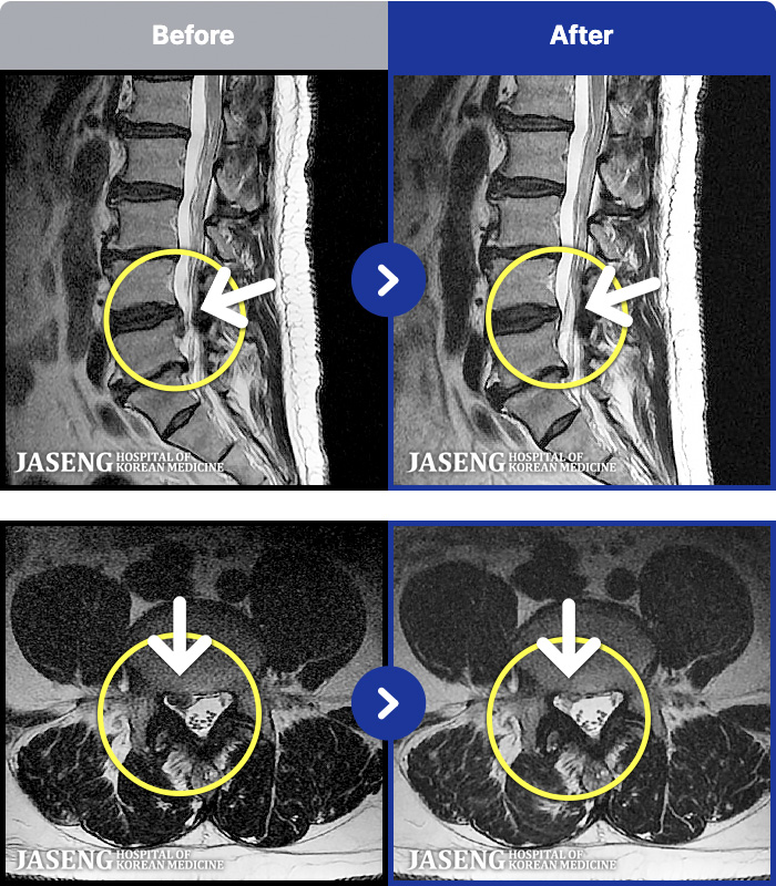 수원자생한방병원 치료 전후 MRI 비교 이미지