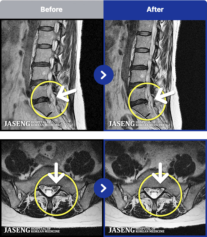 수원자생한방병원 치료 전후 MRI 비교 이미지
