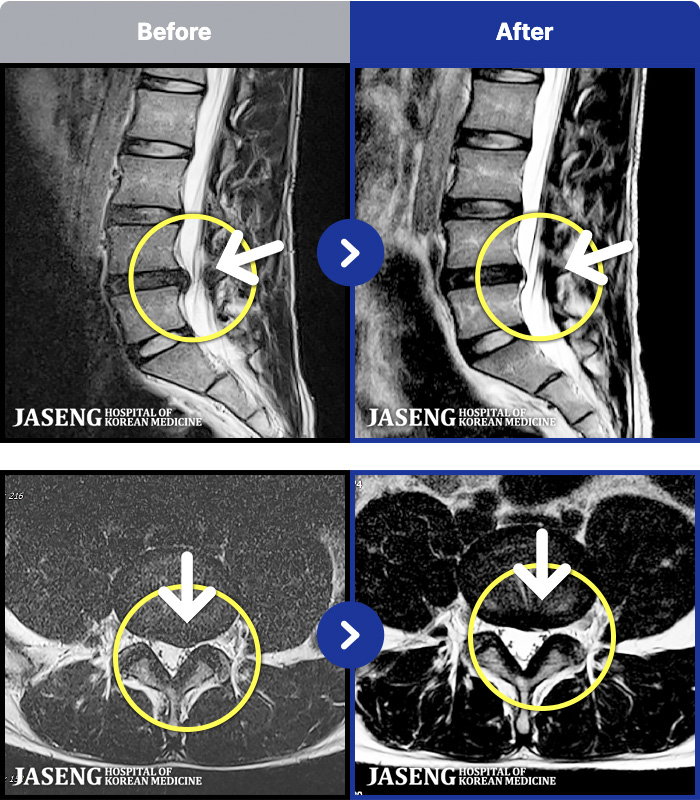 천안자생한방병원 치료 전후 MRI 비교 이미지