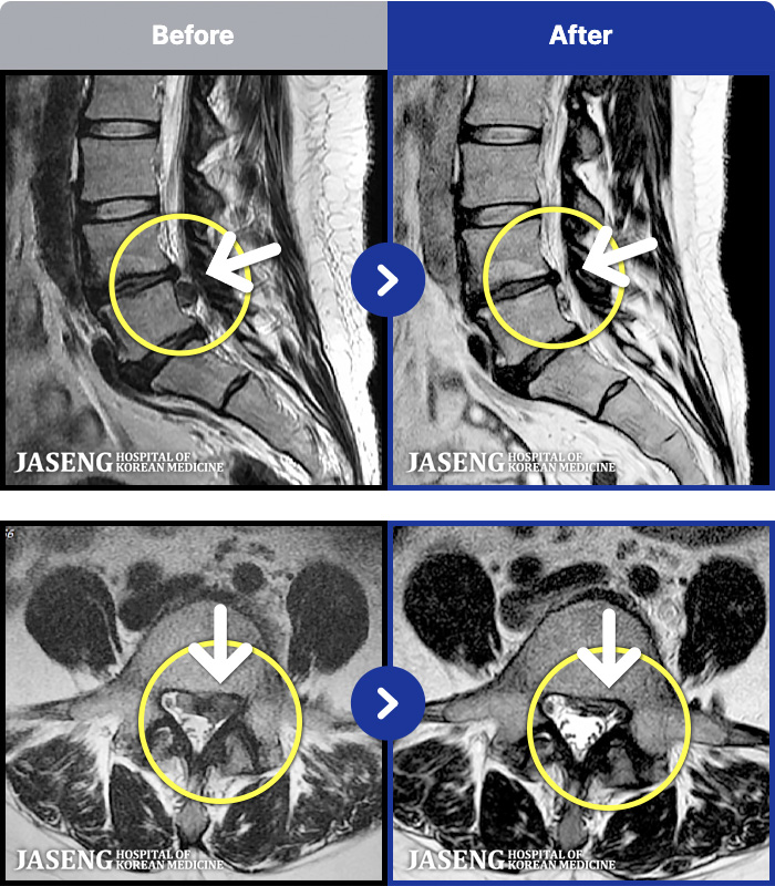 천안자생한방병원 치료 전후 MRI 비교 이미지