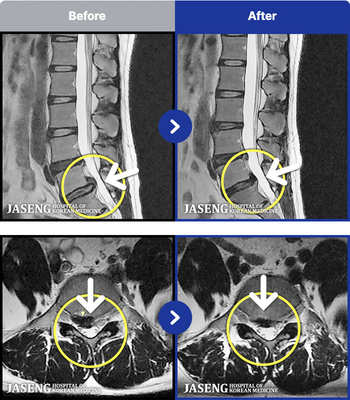 목동자생한방병원 치료 전후 MRI 비교 이미지